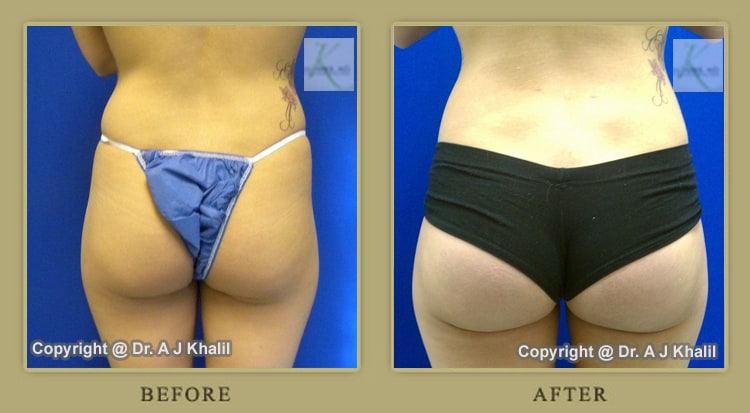 Butt Augmentation Before & After Beverly Hills