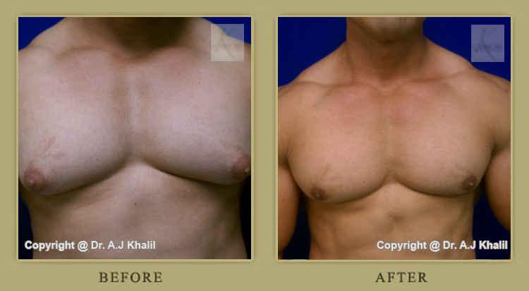 Male breast reduction surgery Los Angeles