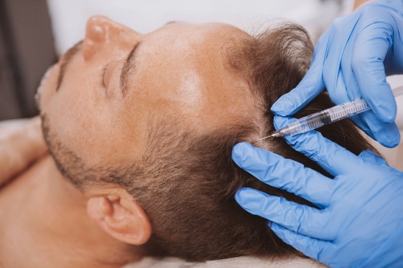 Platelet-Rich Hair Loss Treatment Beverly Hills CA